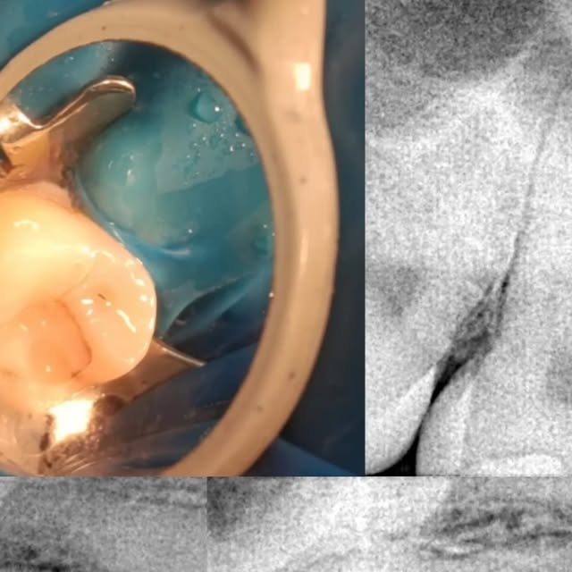 Endodoncia mecanizada en pieza 1.7 con radiografía