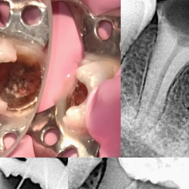 Endodoncia paso a paso con aislamiento y radiografías