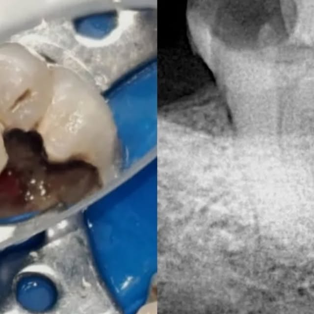 Molar con caries extensa y radiografía del tratamiento de conducto
